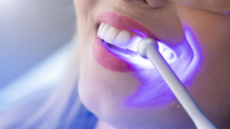 professional smile whitening solutions in Colorado Springs