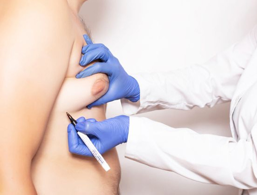 gynecomastia treatment in India